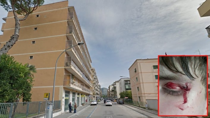 Ragazzino rischia l'occhio per il suo cinquantino