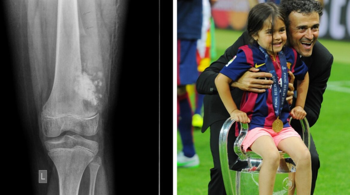 Osteosarcoma, la malattia che ha ucciso la figlia di Luis Enrique: che cos’è?
